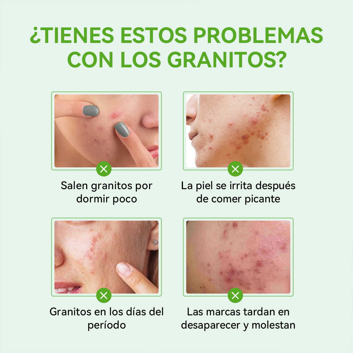 SKINNARSTER Tea Tree Acne Gel (Gel Antiacné de Té de Árbol)